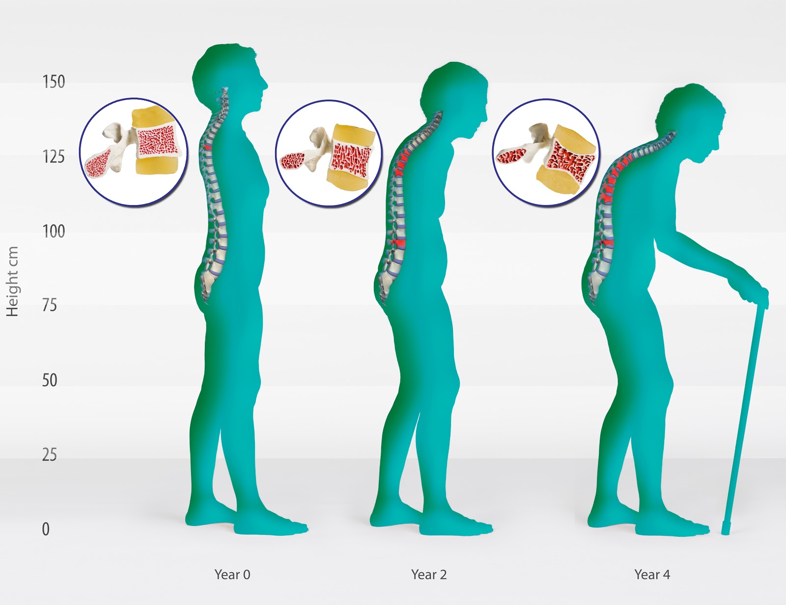 Osteoporosis Stages: Stress and Lifestyle Google image from https://s-media-cache-ak0.pinimg.com/originals/67/c0/02/67c0026b4e378b96798e96404a082b21.jpg