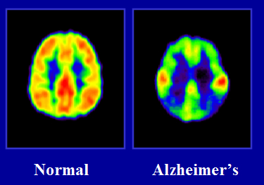 Alzheimer's Brain Google image from http://presbyc-m.com/alzheimers.jpg