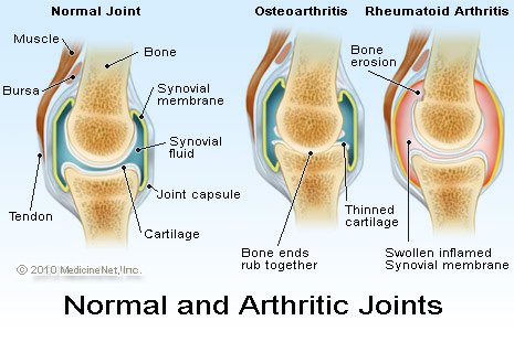 Understanding Arthritis Google image from http://images.medicinenet.com/images/illustrations/arthritic_joints.jpg
