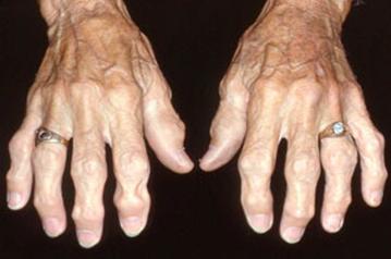 Arthritis of the Hands, Management of patients with arthritic syndrome Google image from https://www.cedars-sinai.org/health-library/diseases-and-conditions/o/osteoarthritis.html