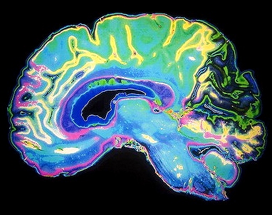 Dementia Brain Google image from http://images.theage.com.au/2012/06/22/3397994/Dementia-20120622210803826299-420x0.jpg