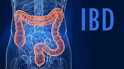 What is Inflammatory Bowel Disease (IBD) Google image adapted from https://i.ytimg.com/vi/4dRmrWPhnKM/hqdefault.jpg