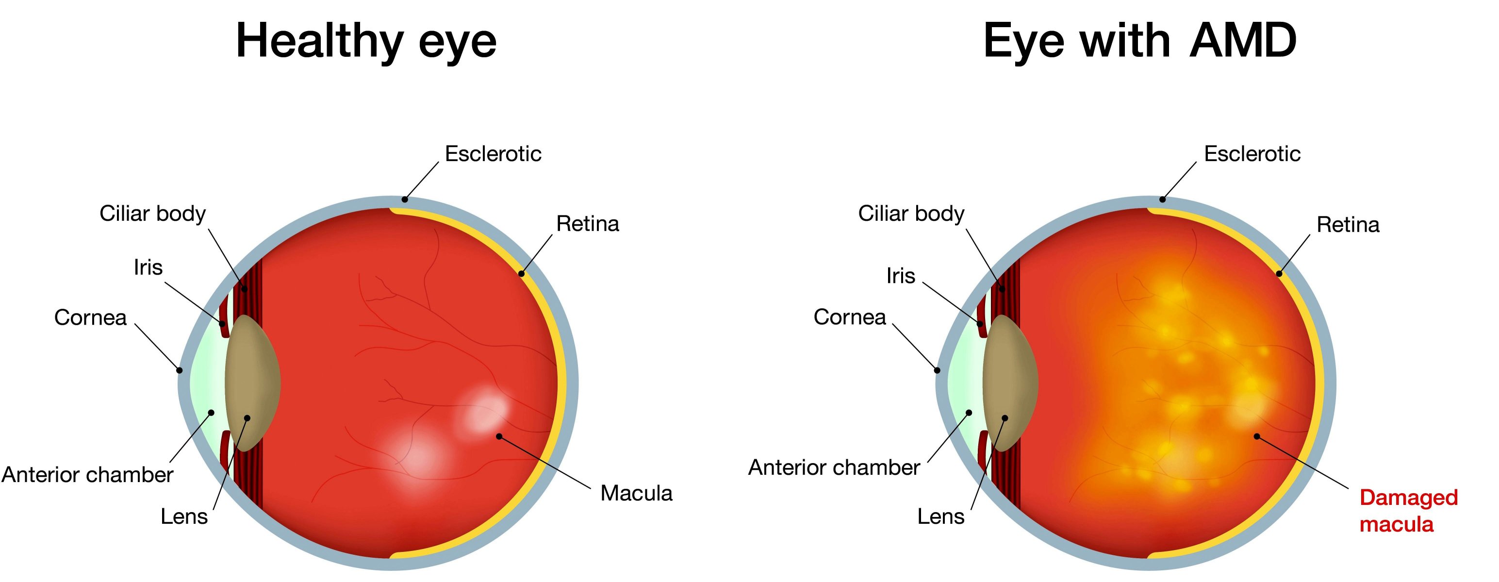 Age Related Macular Degeneration Google image from http://www.dignity-eyecare.co.uk/wp-content/uploads/2017/01/mak-degenation-image-tiny.png