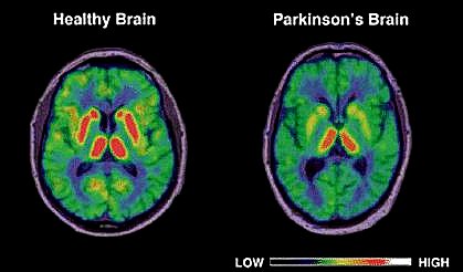 Parkinson's Disease Google image from https://www.researchgate.net/publication/322395084_Evaluating_the_Performance_of_Three_Classification_Methods_in_Diagnosis_of_Parkinson's_Disease