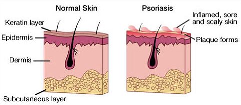 Psoriasis Google image from http://healingherbs.ie/2013/04/understanding-psoriasis/