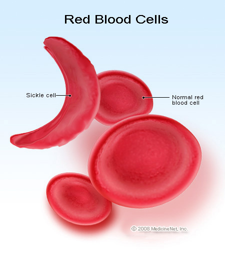 Sickle Cell and Normal Red Blood Cells Google image from http://images.medicinenet.com/images/illustrations/sickl_cell.jpg